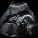 Frauenarztpraxis Tamkan Ultraschalldiagnostik in der Schwangerschaft