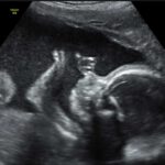 Frauenarztpraxis Tamkan Ultraschalldiagnostik in der Schwangerschaft